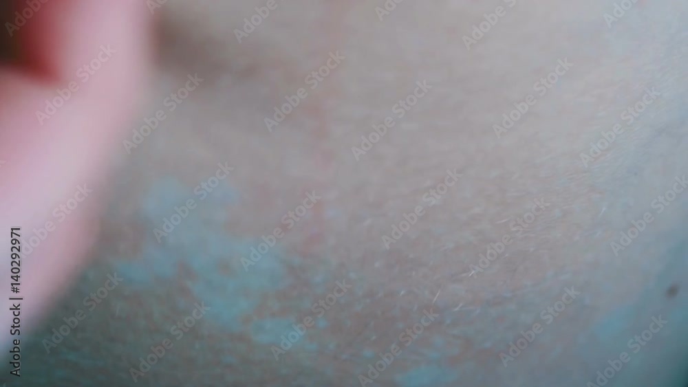 Disease of the skin, color deprive, fungus on the skin Disease of the skin, color deprive, fungus on the skin