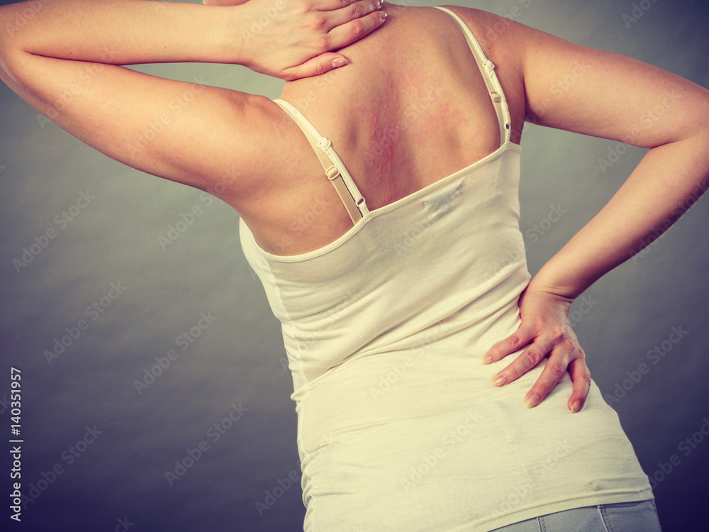 woman scratching her itchy back with allergy rash woman scratching her itchy back with allergy rash
