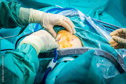 Photography Orthopedic surgeons hand performing human knee arthroscopic surgery