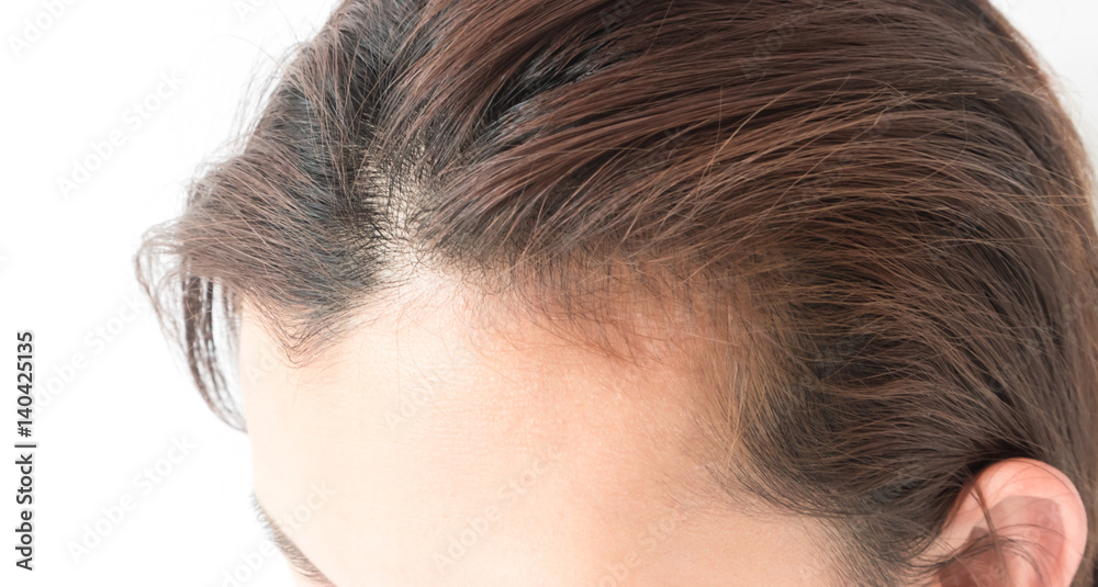 Woman serious hair loss problem for health care shampoo and beauty product concept Woman serious hair loss problem for health care shampoo and beauty product concept