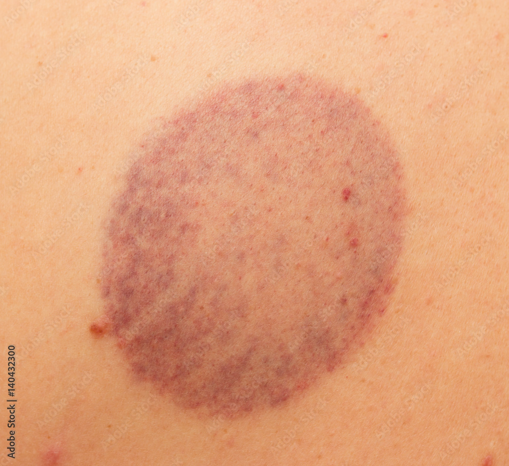 Fototapeta premium bruises on the skin of the back
