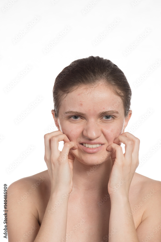 Beautiful young girl with red and white acne on her face. Before and after cream with sponge on a white background. Beautiful young girl with red and white acne on her face. Before and after cream with sponge on a white background.