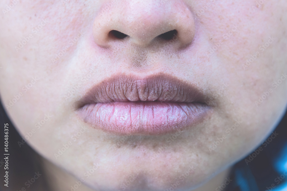 Fototapeta premium Closeup asian woman face with brittle and dry lips