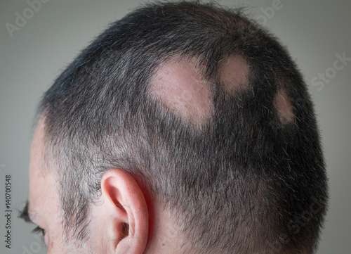 Alopecia Aerata - Spot Baldness