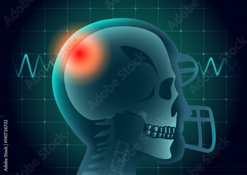 Skull of American football athlete have a red signal on physical monitor background. Illustration about medical diagnosis.