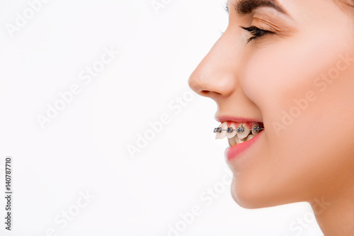 Beautiful young woman with teeth braces photo