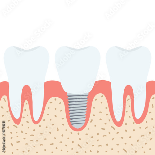 Medical denture. Human teeth, dentist implant in cartoon flat style.