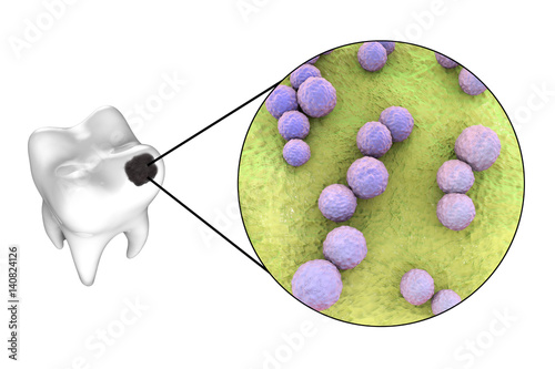 Tooth with dental caries and close-up view of microbes which cause caries Streptococcus mutans, 3D illustration photo