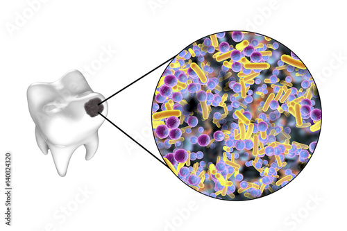 Tooth with dental caries and close-up view of microbes which cause caries, 3D illustration photo