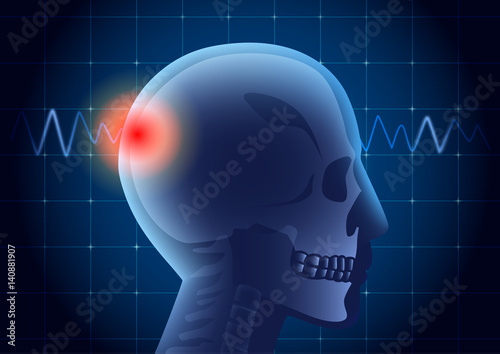 Skull of American football athlete have a red signal on physical monitor background. Illustration about medical diagnosis.