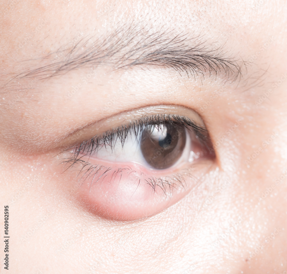 Close up of eyelid abscess (stye, hordeolum) Close up of eyelid abscess (stye, hordeolum)