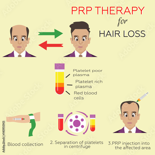  Effective treatment age of hair loss in men. Platelet rich plasma injection. PRP therapy process.  Meso therapy. Hair growth stimulation.