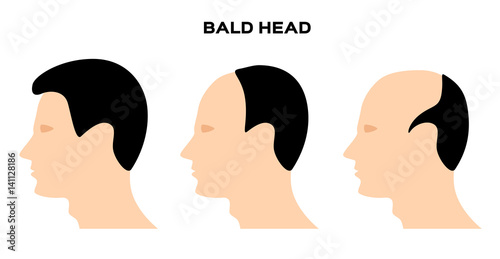 bald head vector . no hair
