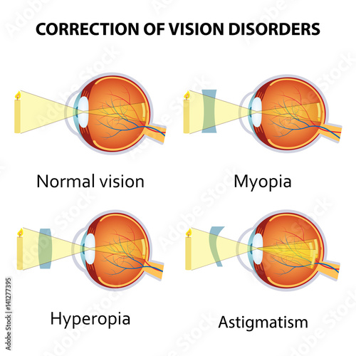 Correction of eye vision disorders by lens.