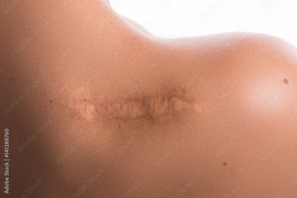 Woman with a scar on her shoulder Woman with a scar on her shoulder