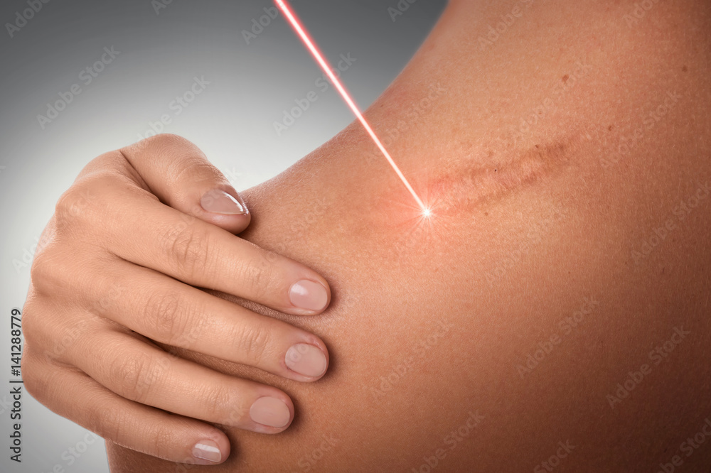 Fotografía Laser scar removal treatment | Posters.es