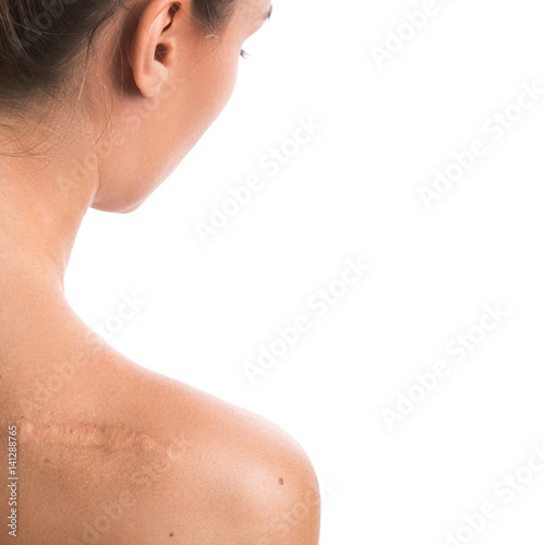 Woman with a scar on her shoulder