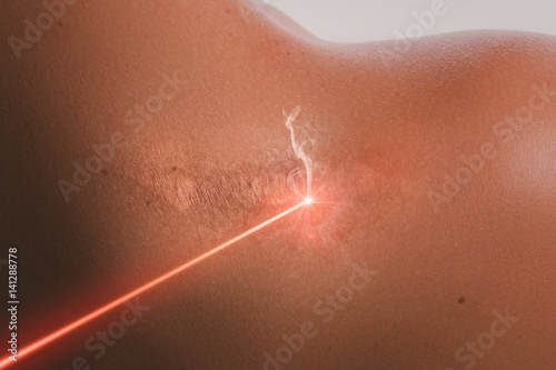 Laser scar removal treatment