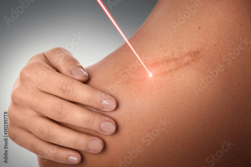 Photographie Laser scar removal treatment