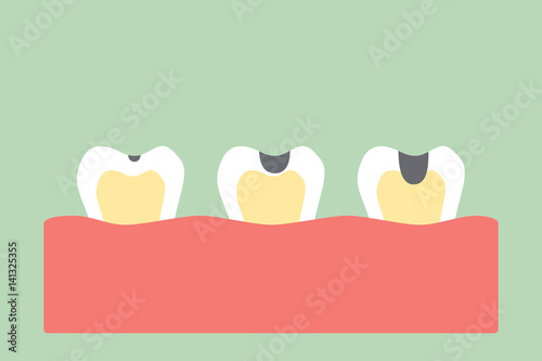 stages of tooth decay