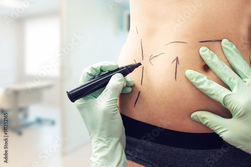 plastic surgeon marking womans body for surgery photo