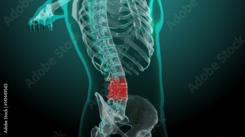 X-ray skeleton animation of lower back spine pain