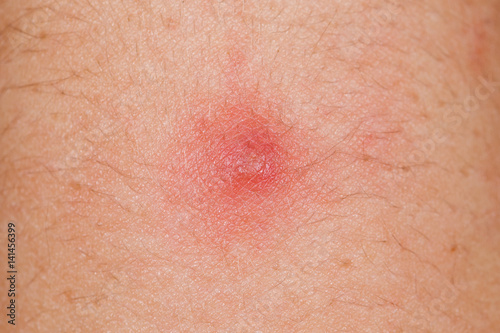 Red pimple on human skin photo
