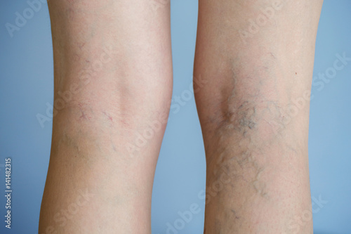 Photos Varicose veins