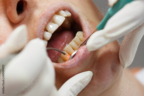 Obraz na płótnie Dental laser used on a patient w salonie