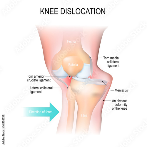 Knee dislocation.
