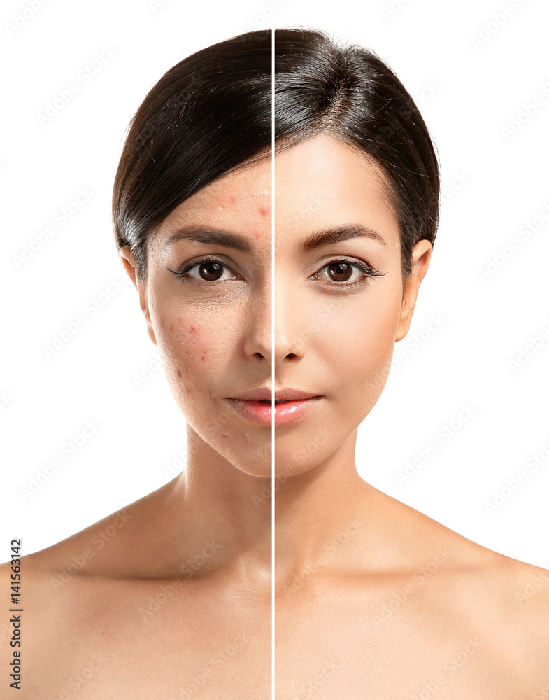 Woman face before and after acne treatment procedure. Skin care concept