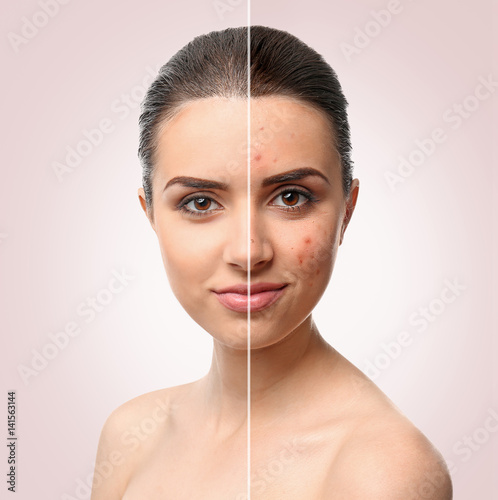 Woman face before and after acne treatment procedure. Skin care concept. photo