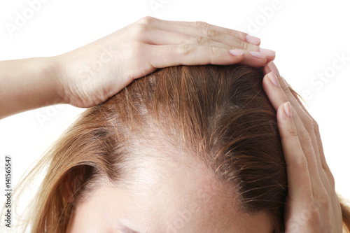 Young woman with hair loss problem on white background, closeup photo