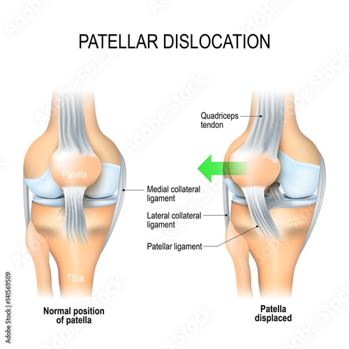 Patellar dislocation photo
