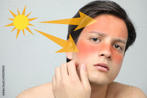 young man with a bad sunburn on his face