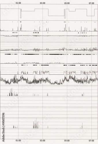 polysomnography (PSG) sleep study