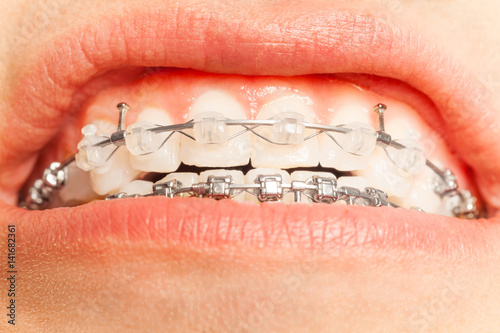 Close-up of man mouth with tooth correction braces