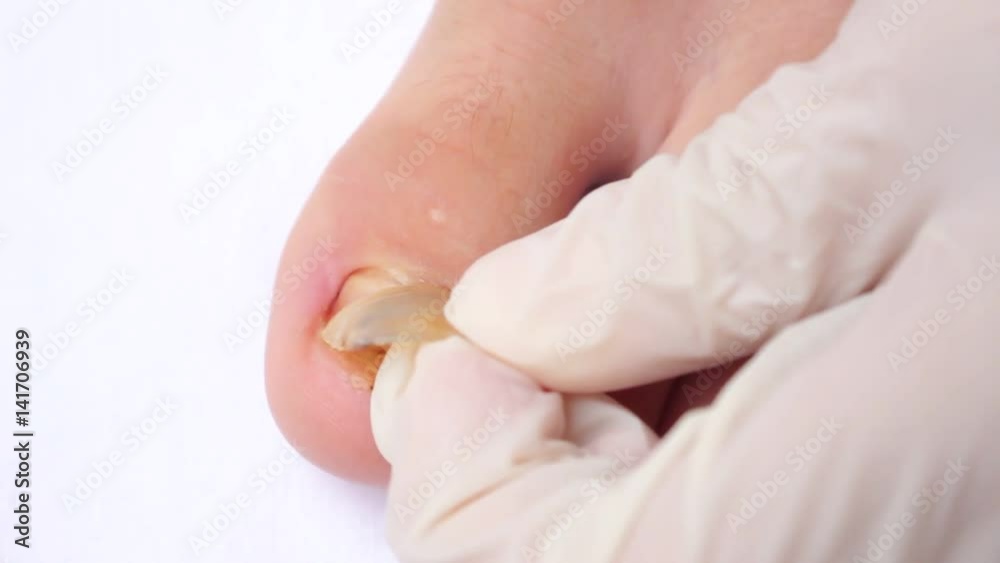 The injured nail removed by a small operation done under local anaesthetic. Nail loss. Underneath the nail plate there lies the nail bed The injured nail removed by a small operation done under local anaesthetic. Nail loss. Underneath the nail plate there lies the nail bed