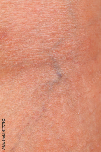 Varicose spider veins on young female's leg