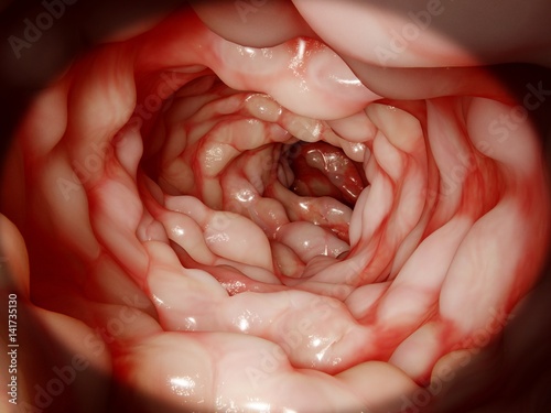 Darm, Morbus Crohn.
Morbus Crohn ist eine chronisch-entzündliche Darmkrankheit. photo