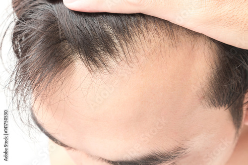 Young man serious hair loss problem for health care shampoo and beauty product concept