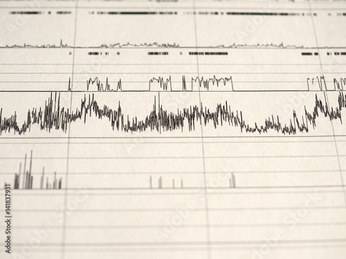 polysomnography (PSG) sleep study