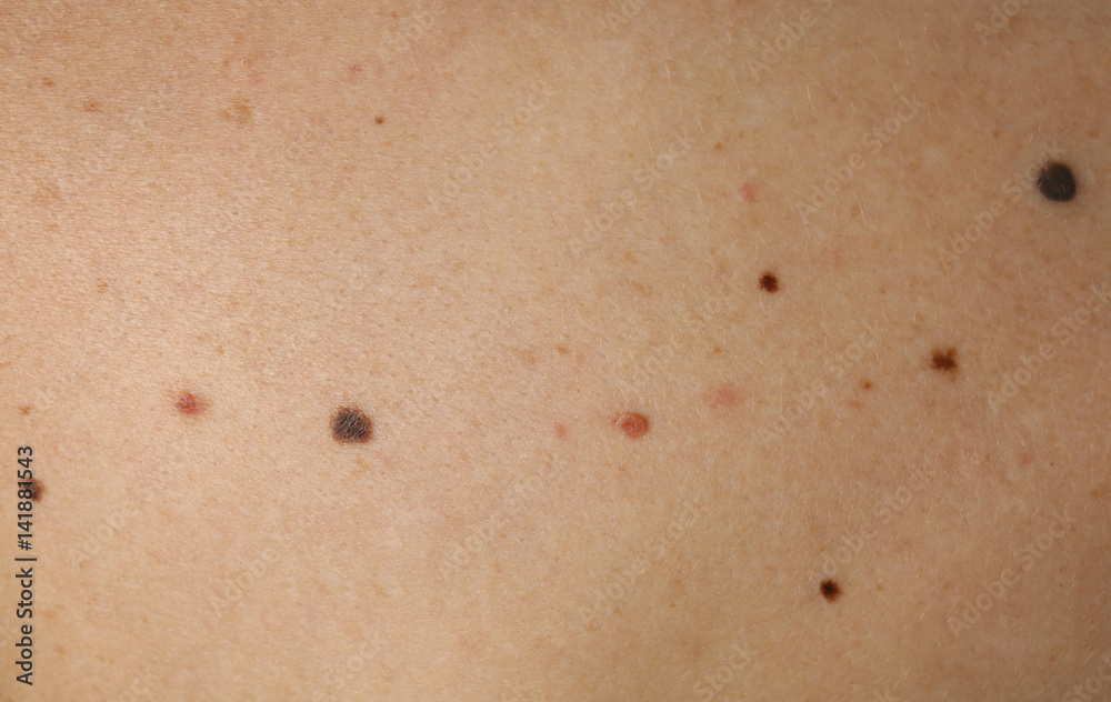 Fototapeta premium Human skin with birthmarks, closeup