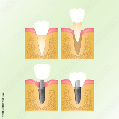 implantation of the tooth