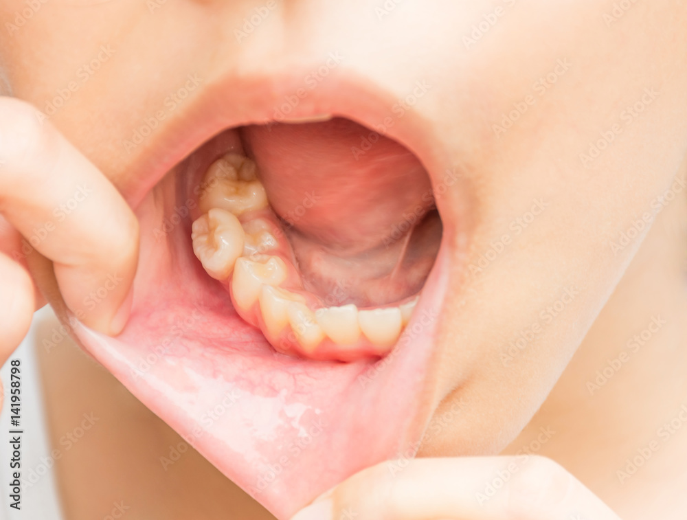 Fototapeta premium In the mouth of this child with permanent teeth up insert the milk teeth that have not dropped.