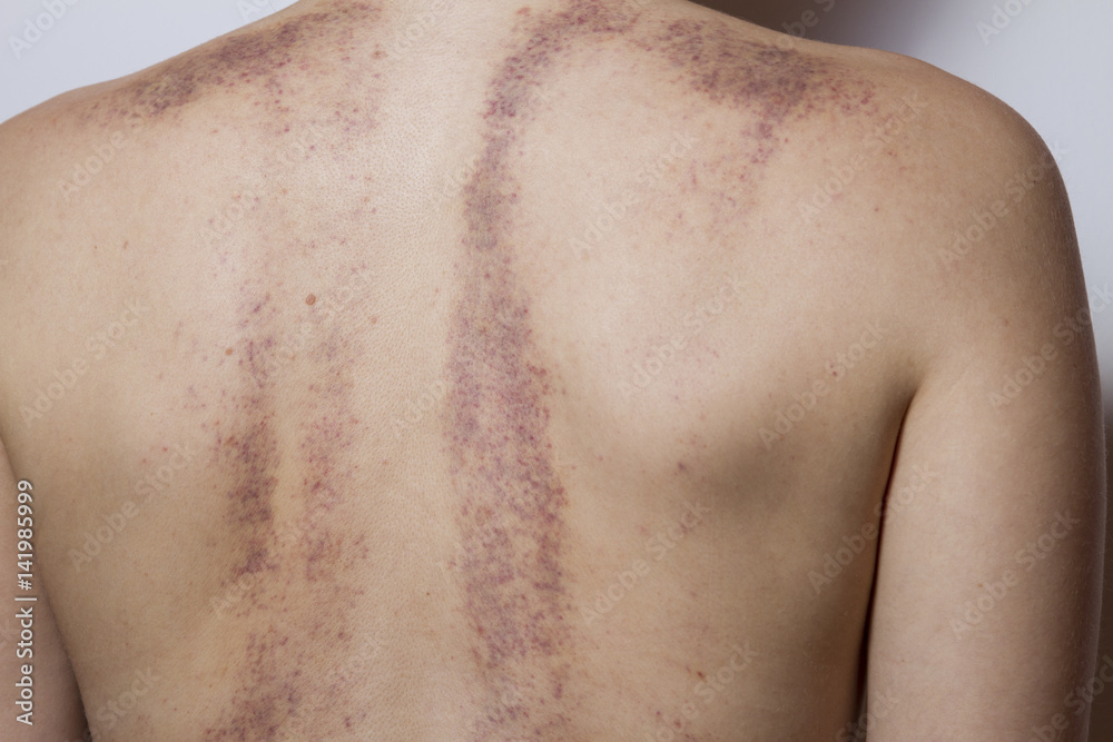 Fototapeta premium Rear view of a woman with bruises on white background.