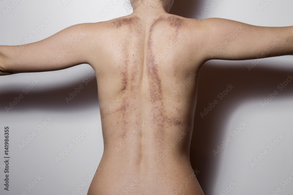 Rear view of a woman with bruises on white background. - obrazy, fototapety, plakaty 