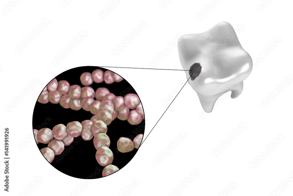 Tooth with dental caries and close-up view of microbes which cause ...