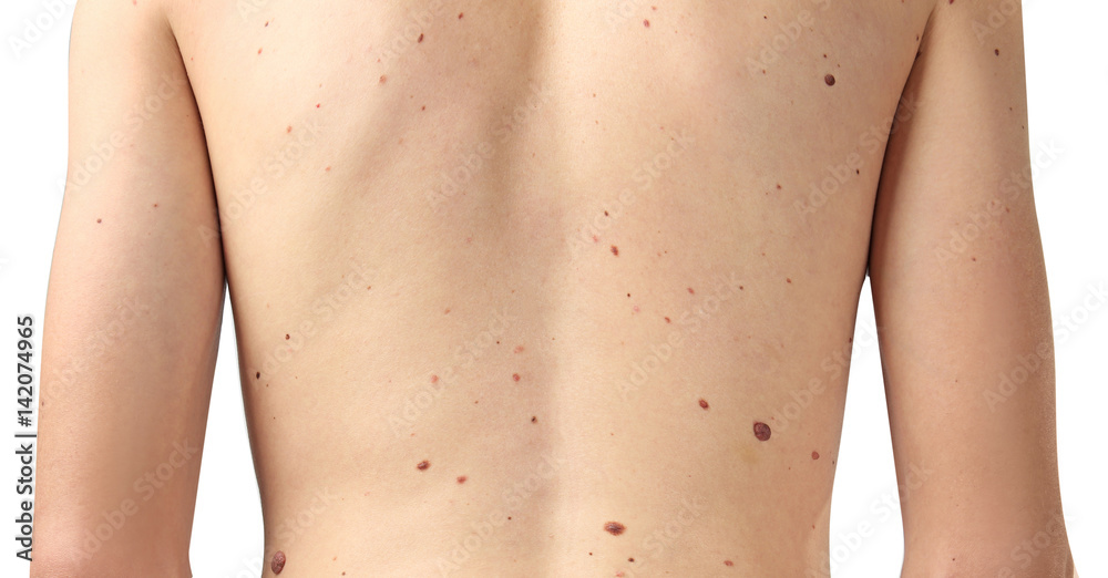 Young man with birthmarks on light background, closeup Young man with birthmarks on light background, closeup