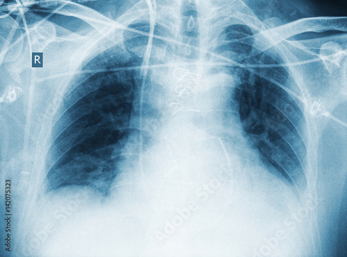 X-ray of patient after surgery with pneumonia photo